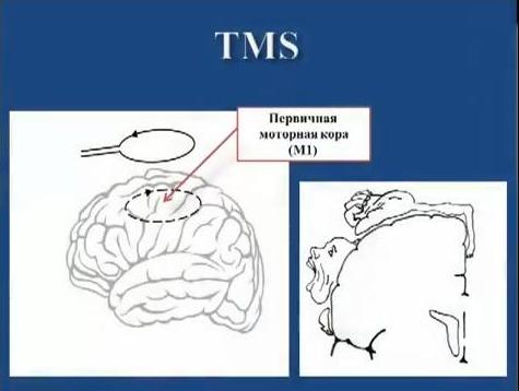 Транскраниальная магнитная стимуляция